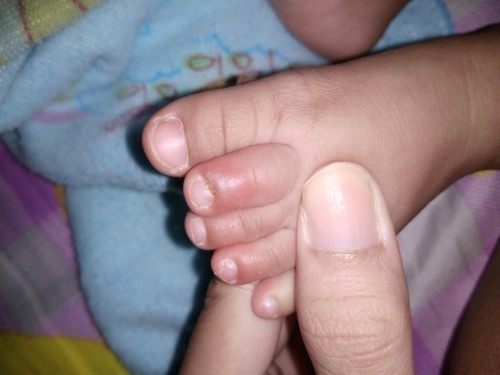 นิ้วลูกเป็นหนอง