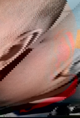 Redness spot on face