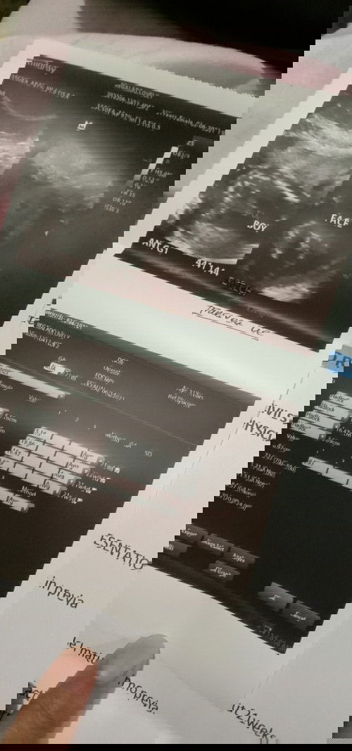 Masakit ang pusod ko im going to 6months po this end of the month nagaalala ako msakit ang pusod ko