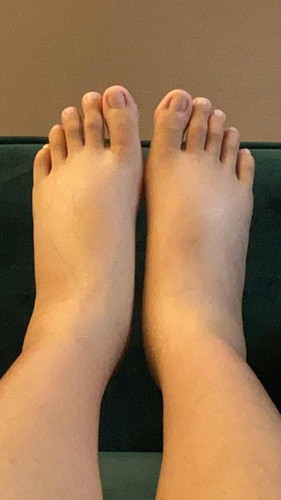 Swollen feet