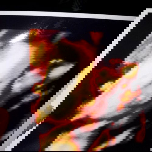 Hasil usg dan hpht berbeda