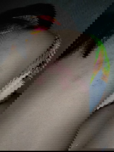 ตอนนี้จะเข้าเดือนที่8แล้วค่ะแต่ดันมาเป็นงูสวัด จะมีผลอะไรต่อน้องในท้องมั้ยคะ