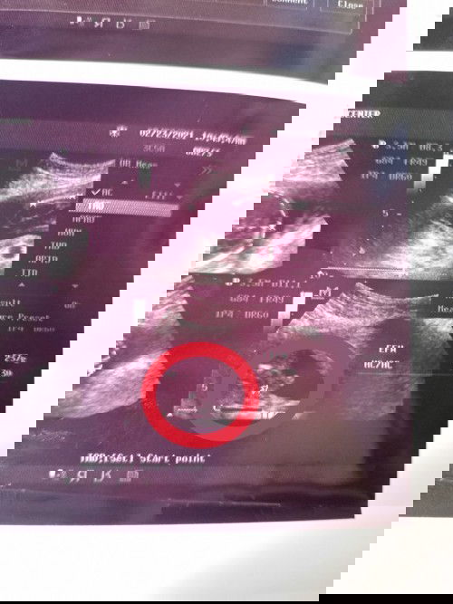 20weeks & 2Days 💗 
TEAM JULY ✋
ITS A BABY BOY AGAIN! 😬😁