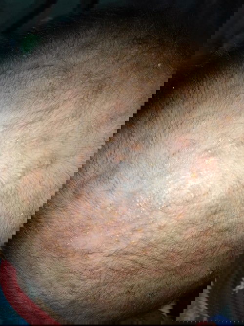 แม่ๆบ้านไหนลูกเป็นผื่นคันขึ้นหัวแบบนี้บ้างค่ะใช้อะไรถึงจะหายแม่บ้านนี้พาไปหาหมอก้แล้วเป็นๆหายๆ