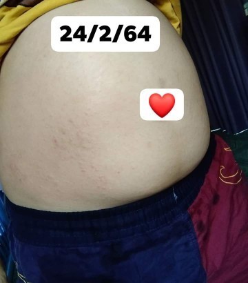 แม่ๆท้อง3ท้องลายกันบ้างไหมค่ะ