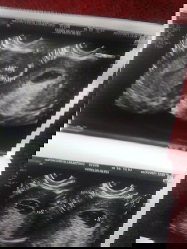 7 weeks no fetal pole seen
minimal subchorionic hemorrhage
sino po naka experience sa inyo nito?