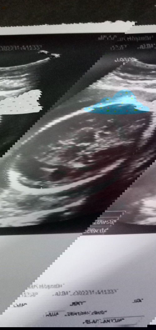 28สัปดาห์7เดือน กลับหัวแล้ว  ตามอายุครรภ์เร็วไปมั้ยค่ะ😊