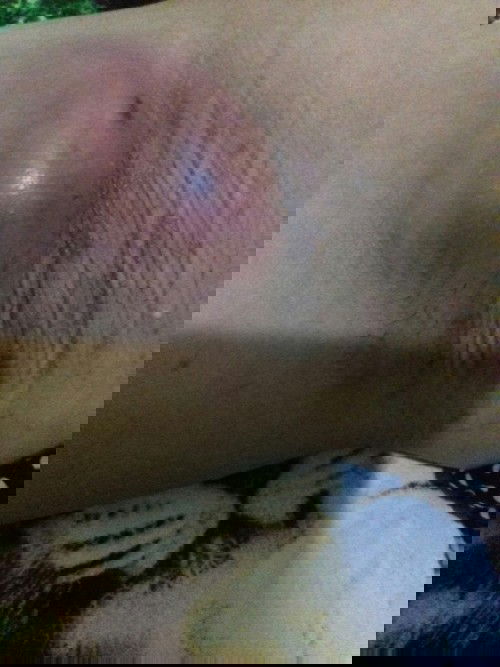 Tumbuh benjolan di ketiak saat hamil muda dan pertama banget ngalaminnya