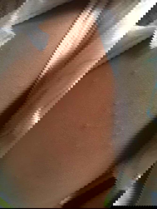 Bintik bintik di paha