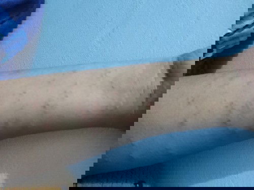 bintik-bintik merah gatal