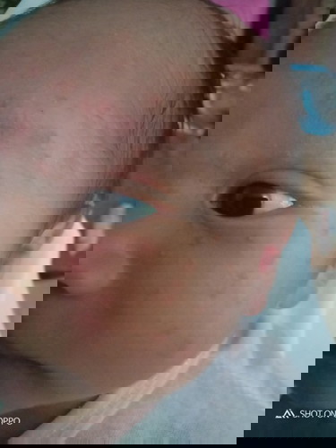 acne problem