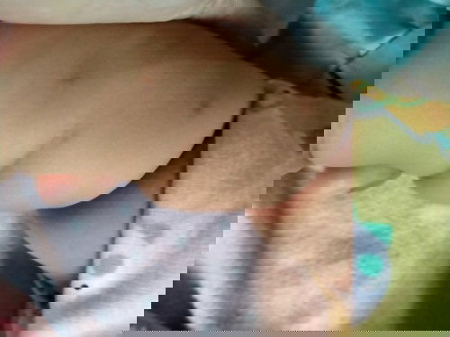 Cara menghilangkan Bekas gigitan serangga/nyamuk.