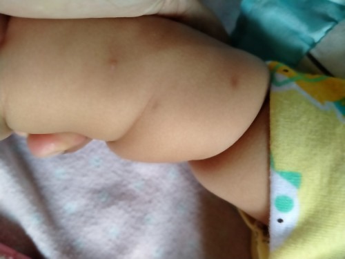 Cara menghilangkan Bekas gigitan serangga/nyamuk.