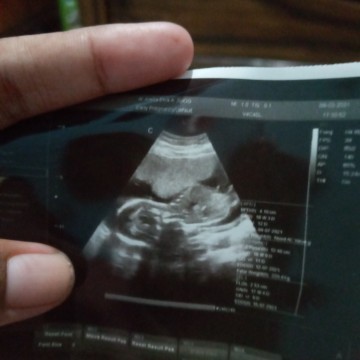 Bun hamil 21minggu kira2 di USG 4D uda jelas blm ya jenis kelamin nya,kmren bru USG tp hitam putih