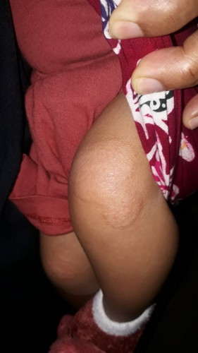 Ruam di lutut bayi