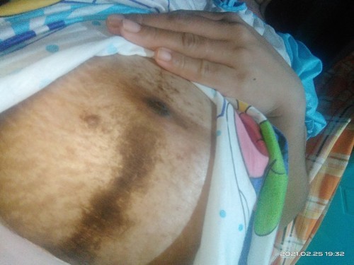 Masakit na tahi ng cs aftrr 4 yrs. 7months preggy