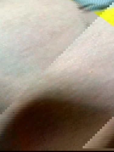 เป่นผื่นแดงๆรอบนมค่ะ เราใช้เบบี้ออย กะนีเวีย ตอนยังไม่ใช้ไม่ขึ้นแบบนี้ค่ะคันยิบๆแต่ไม่กล้าเกากลัวแตก