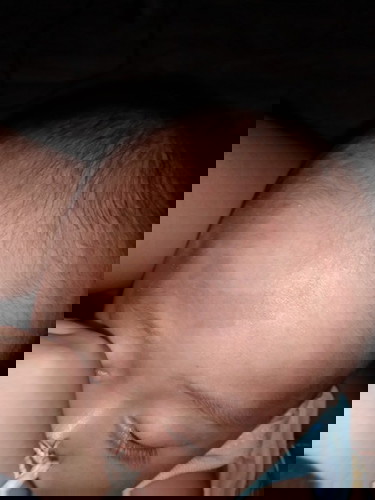 ปานแบบนี้จะหายมั้ยคะ?