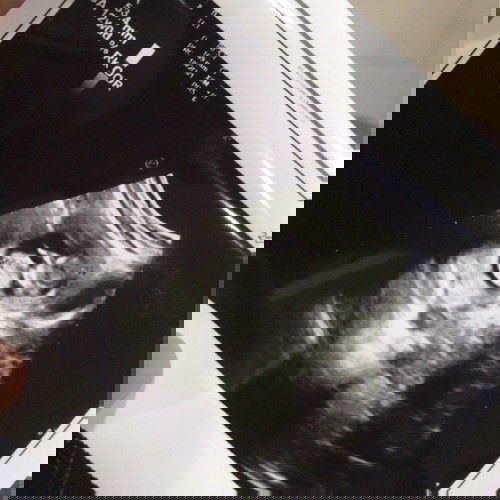 Pendarahan karena plasenta previa