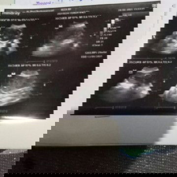 Bun ada yg sma an gk tiap usg jk y gak kliatan soal y debay y aktip bngt jdi gk jelas susah liat ny