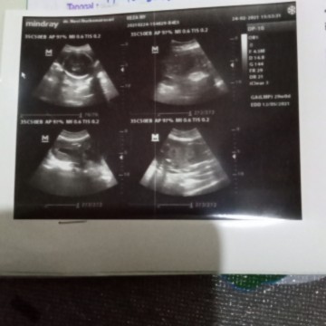 Bun ada yg sma an gk tiap usg jk y gak kliatan soal y debay y aktip bngt jdi gk jelas susah liat ny