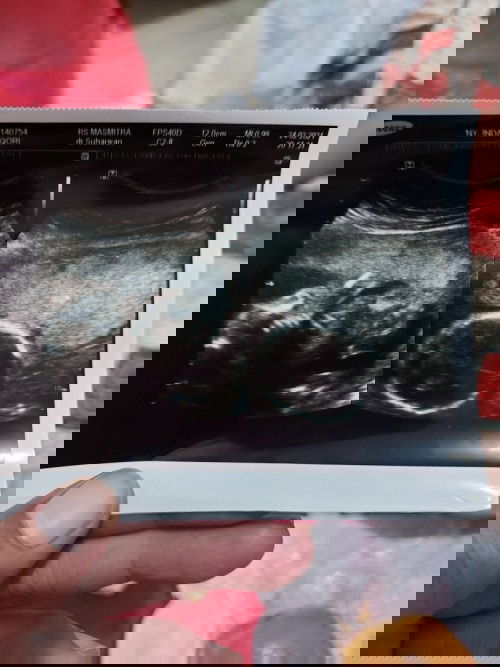 bun , adakah yang pernah usg usia kandungan 20 minggu dan plasenta masih dibawah? minta saran ya bun