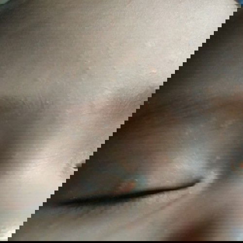 gatal pada wajah bayi