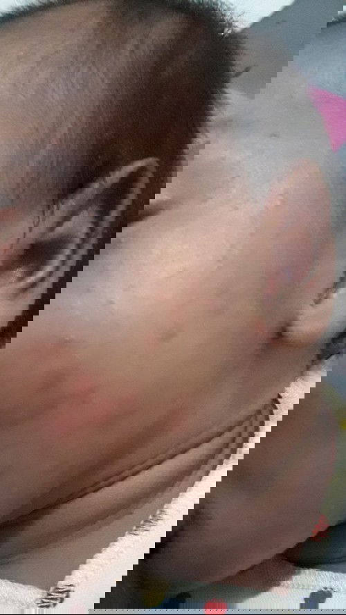 Bintik-bintik merah d pipi