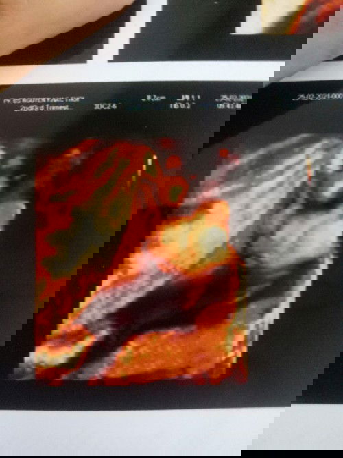 Mn cho em hỏi là từ tuần 22 e đi khám thì phát hiện dây rốn quấn cổ 1 vòng.. Đến giờ là 33 tuần