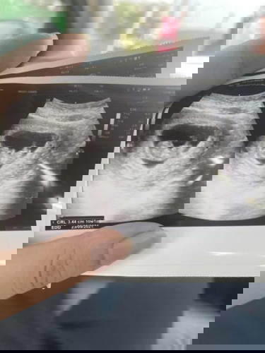 10W1D หัวใจเต้น 160 คุณหมอบอกให้นอนพักเยอะๆ