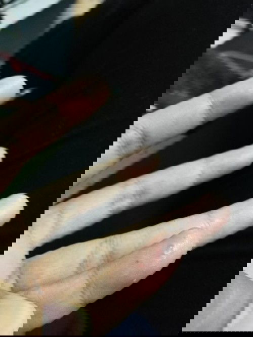 Hai. Siapa pernah alami macam ni? Mula2 naik benjol2 kecil, then rasa mencucuk and now jadi gatal2.