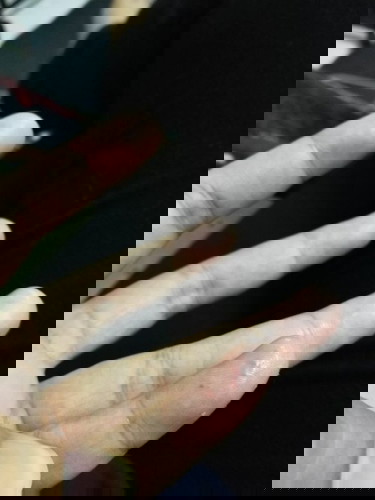 Hai. Siapa pernah alami macam ni? Mula2 naik benjol2 kecil, then rasa mencucuk and now jadi gatal2.