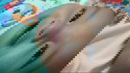 Kemerahan di PIPI Bayi