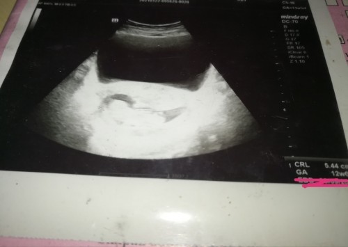Scan ada heartbeat tapi baby tak gerak.