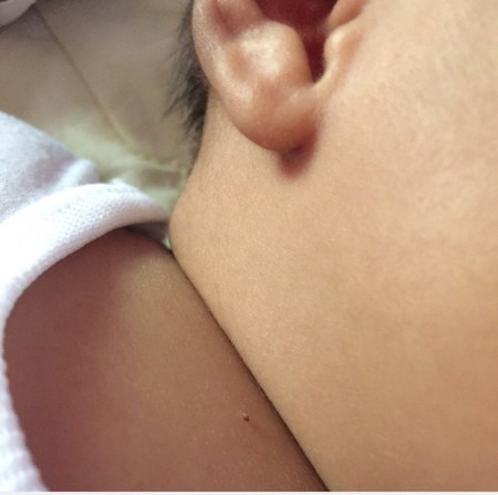 Warts at 1 month old