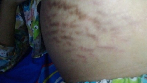 Strechmarks Padahal Ga Digaruk