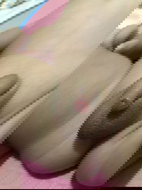 SWELLING PRIVATE PART OF A BABY