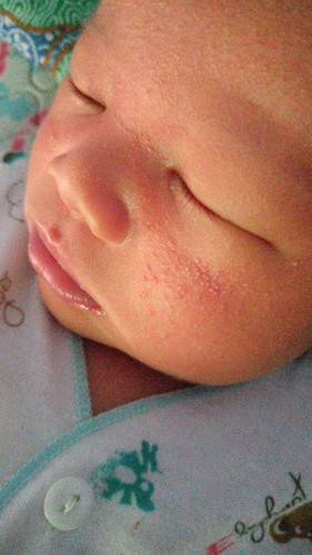 Bun mau nanya anak saya di pipi pada bruntus...cra ngilangin nya pakai apa ya bun..serius nanya?????