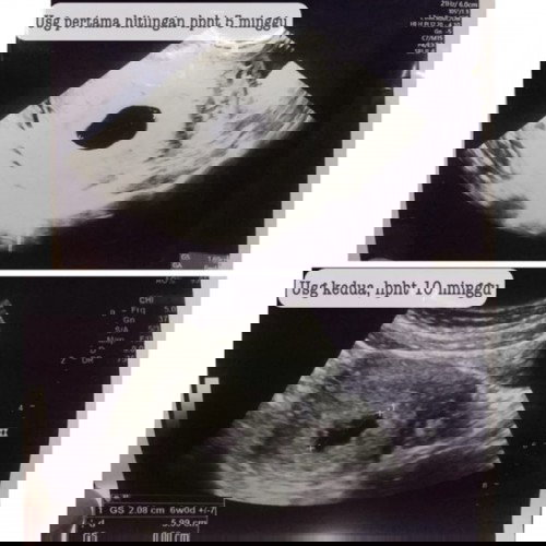 Diagnose Kehamilan Kosonh