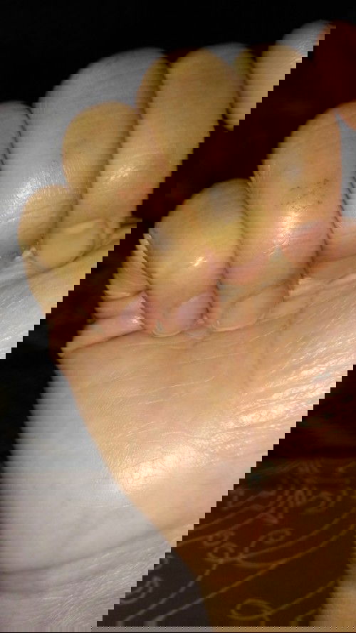 Tangan perih dan luka tiba2