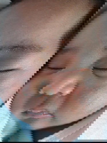 Eyebrow Cradle cap and face rashes