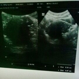 USG setelah keluar darah