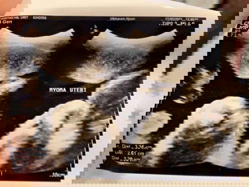 ตรวจพบเนื้องอกขณะตั้งครรภ์