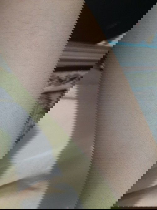 Muncul Bintik2 merah tapi tidak gatal