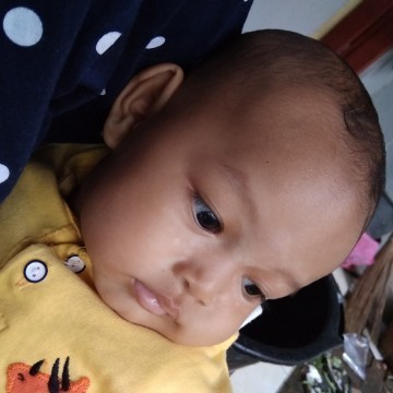 Bercak putih wajah bayi