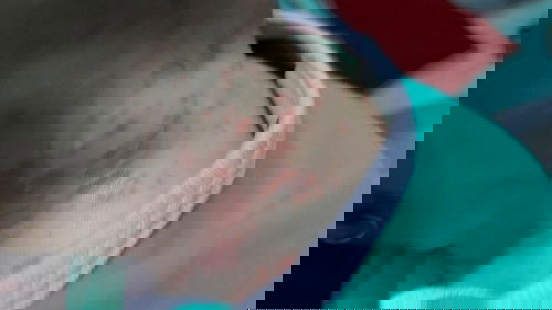 Bintik bintik merah dibelakang kepala