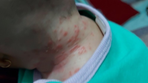 Bintik bintik merah dibelakang kepala