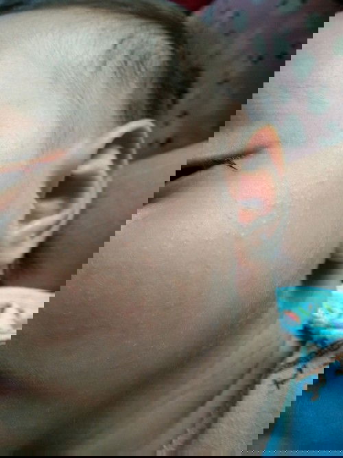 Bintik-bintik di wajah bayi