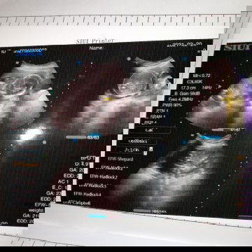 Bun ini USG anak pertama saya