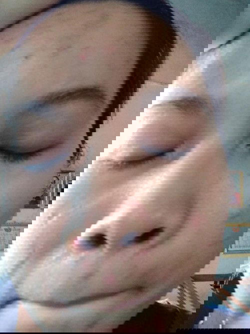 Các m bjk làm ntn để hêt mụn hk ạ.e bị mụn vs thâm nổi lên qua troi.tự ti ghê.m nao bjk cách chỉ e v